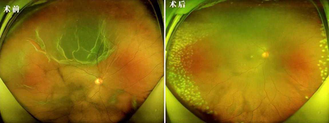 近视手术前竟查出孔源性视网膜脱离，差点视力丧失