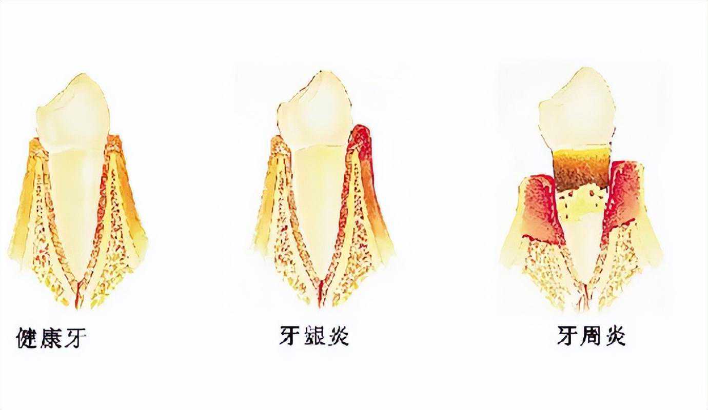 怎么判断牙周炎的严重程度？
